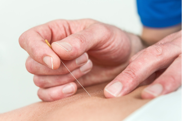 Dry Needling